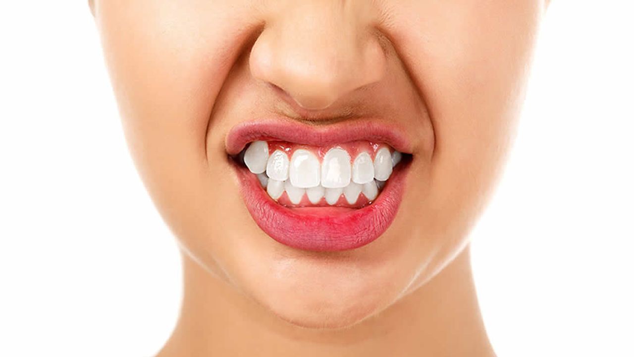 Aşırı Bruksizm, dişlerin çatlamasına, kırılmasına hatta diş kaybına neden olabilir