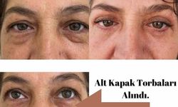 Elmalı Devlet Hastanesi’nde göz kapağı estetik ameliyatları başladı