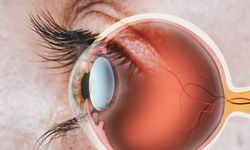 Gözde Işık Parlamaları Retina Yırtığı Habercisi Olabilir!