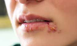 Uçuklara neden olan herpes simpleks virüsü görme kaybına yol açabilir