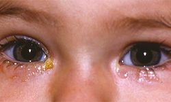 Bebek ve Çocuklarda Göz Sulanması Tedavisi