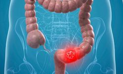 Evde Hayat Kurtaran Adım: Kolon Kanseri Taramasını Ertelemeyin