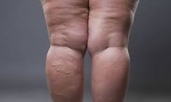 Avrupalı Lipödem Hastalarının Yeni Rotası: Neden İstanbul?