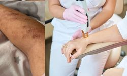 Afşin’de Lazer Epilasyon Skandalı: Kollarında Yanıklar Oluştu!