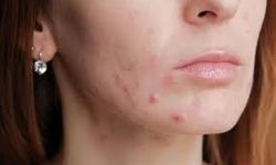 Akne Oluşumuna Yol Açan 7 Hatalı Alışkanlık!