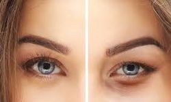 Göz Kapağı Ameliyatı, Sağlık ve Estetik İçin Tercih Ediliyor
