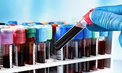 Uzmanından Biotin uyarısı: Kan tahlili öncesi kullanıma ara verilmeli