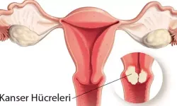 Rahim Ağzı Kanserine Karşı Hayat Kurtaran 4 Kritik Önlem!