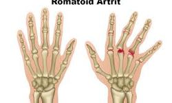Romatoid Artrit Hastalarına 8 Önemli Kış Önerisi!