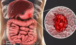 Endoskopi raporlarında geçen “pangastrit” ne anlama geliyor?