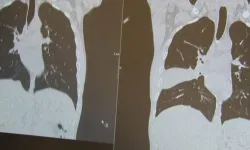 Kanser sanıldı, akciğerinden kemik çıktı! Doktorları bile şaşırttı