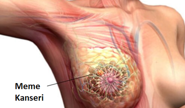 Ailesinde Meme Kanseri Olanlar Prostat Kanseri Açısından Da Risk Altında