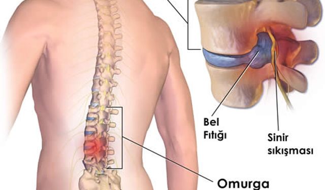 Bel Fıtığı İyileşir mi?