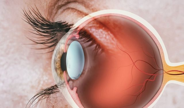 Gözde Işık Parlamaları Retina Yırtığı Habercisi Olabilir!