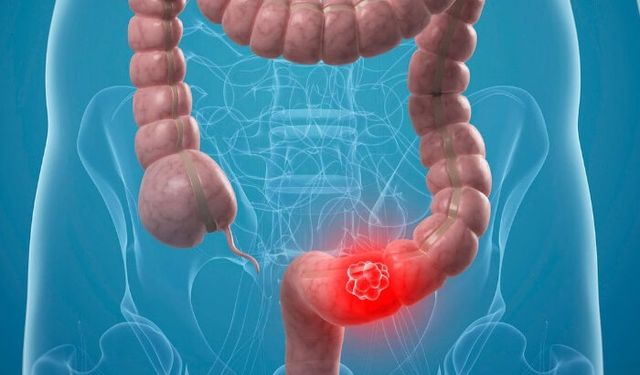 Kolon Kanserinde Erken Tanı Hayat Kurtarıyor!