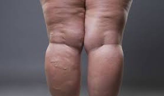 Bu Belirtilerin Nedeni Lipödem Olabilir!