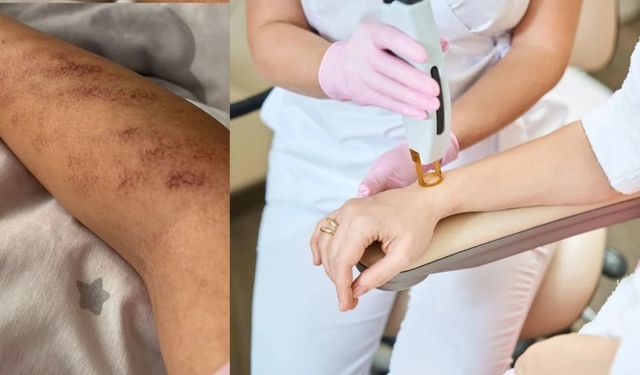 Afşin’de Lazer Epilasyon Skandalı: Kollarında Yanıklar Oluştu!