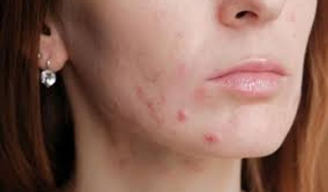Akne Oluşumuna Yol Açan 7 Hatalı Alışkanlık!