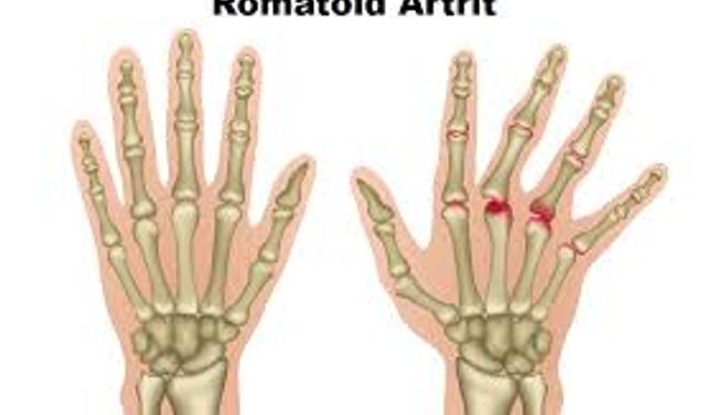Romatoid Artrit Hastalarına 8 Önemli Kış Önerisi!