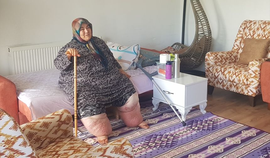 Osmaniye'de yaşayan 160 kilogram ağırlığındaki 'fil hastası' Güler'e tekerlekli sandalye desteği