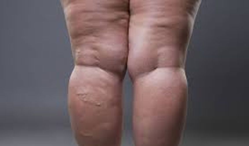 Bu Belirtilerin Nedeni Lipödem Olabilir!