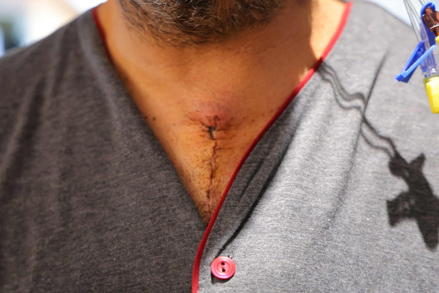 20 Dakika Beyin Dolaşımı Durdurulan Hasta Hayata Döndürüldü (5)