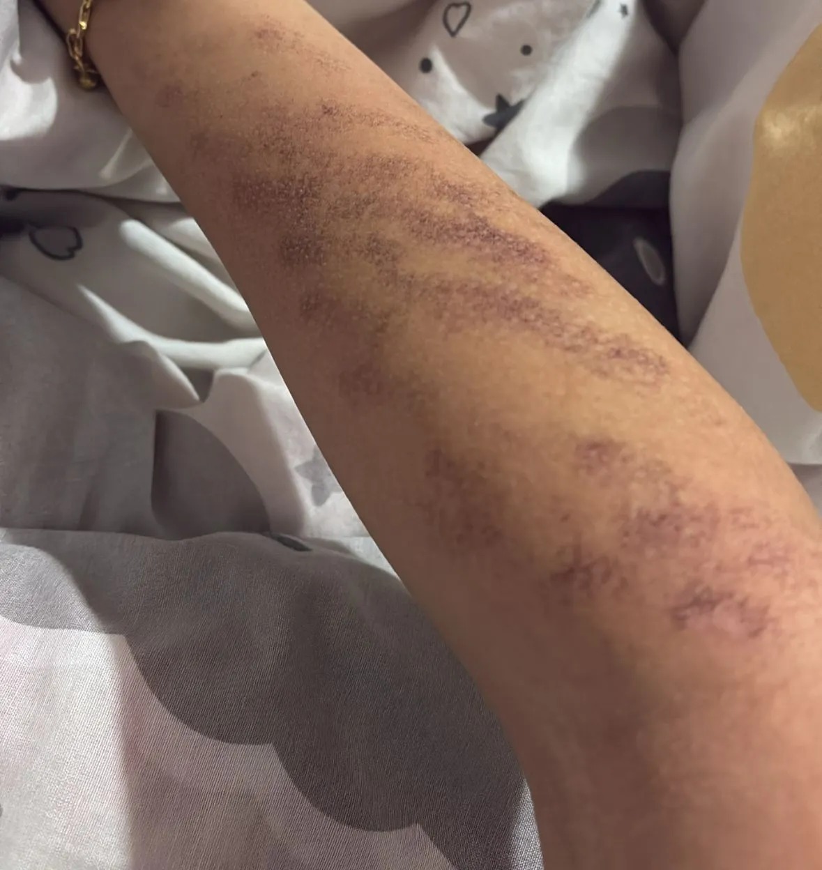 Afşin’de Lazer Epilasyon Skandalı Kollarında Yanıklar Oluştu2