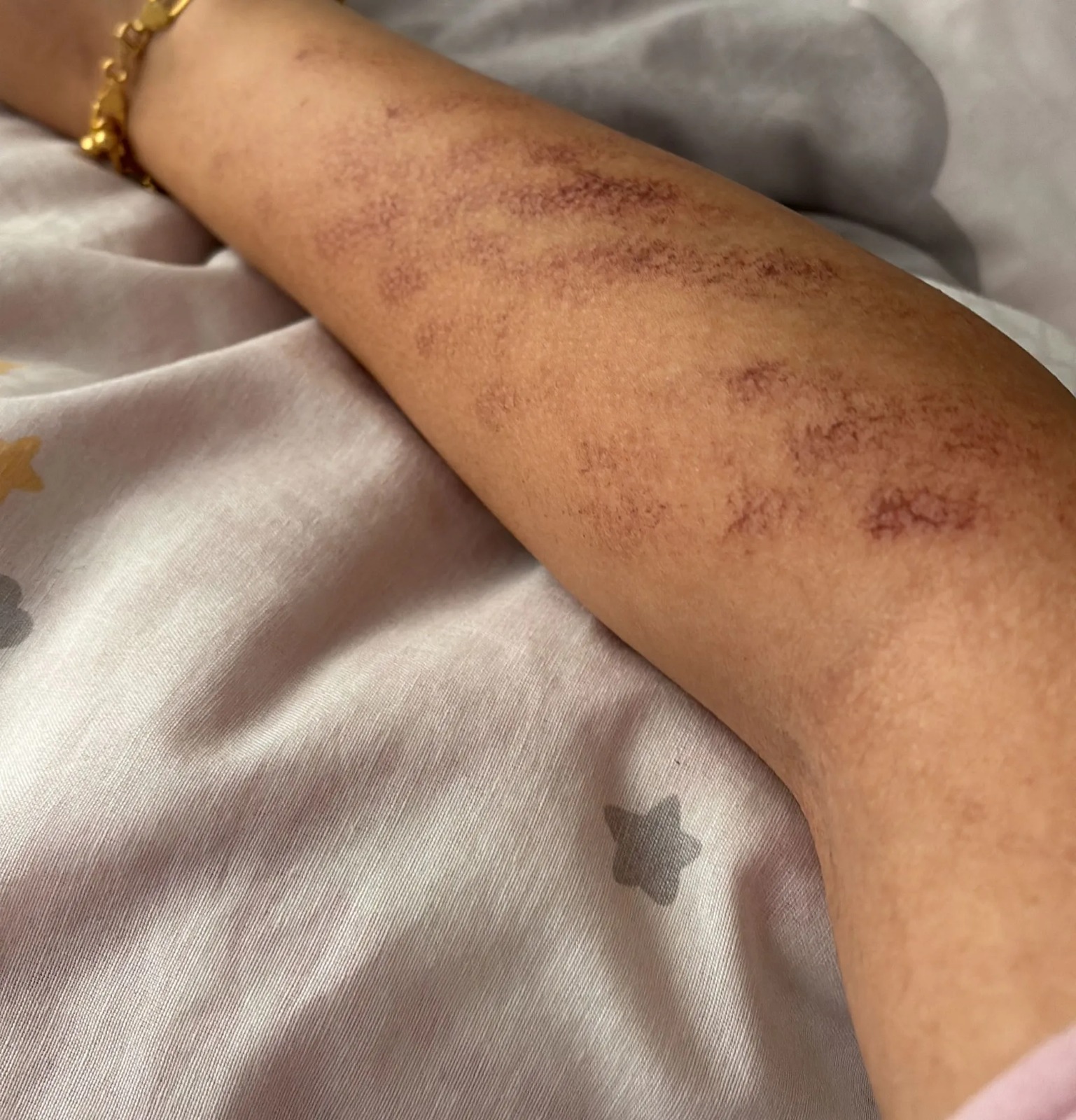 Afşin’de Lazer Epilasyon Skandalı Kollarında Yanıklar Oluştu3