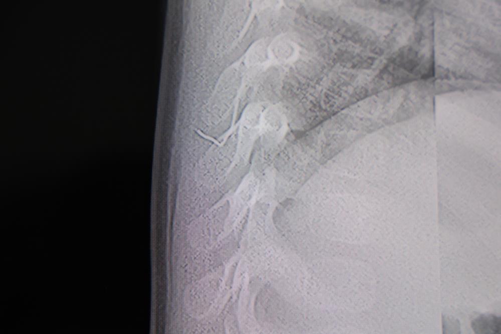 Bebeğin Sırtından Çıkan Tel Parçası Şoke Etti