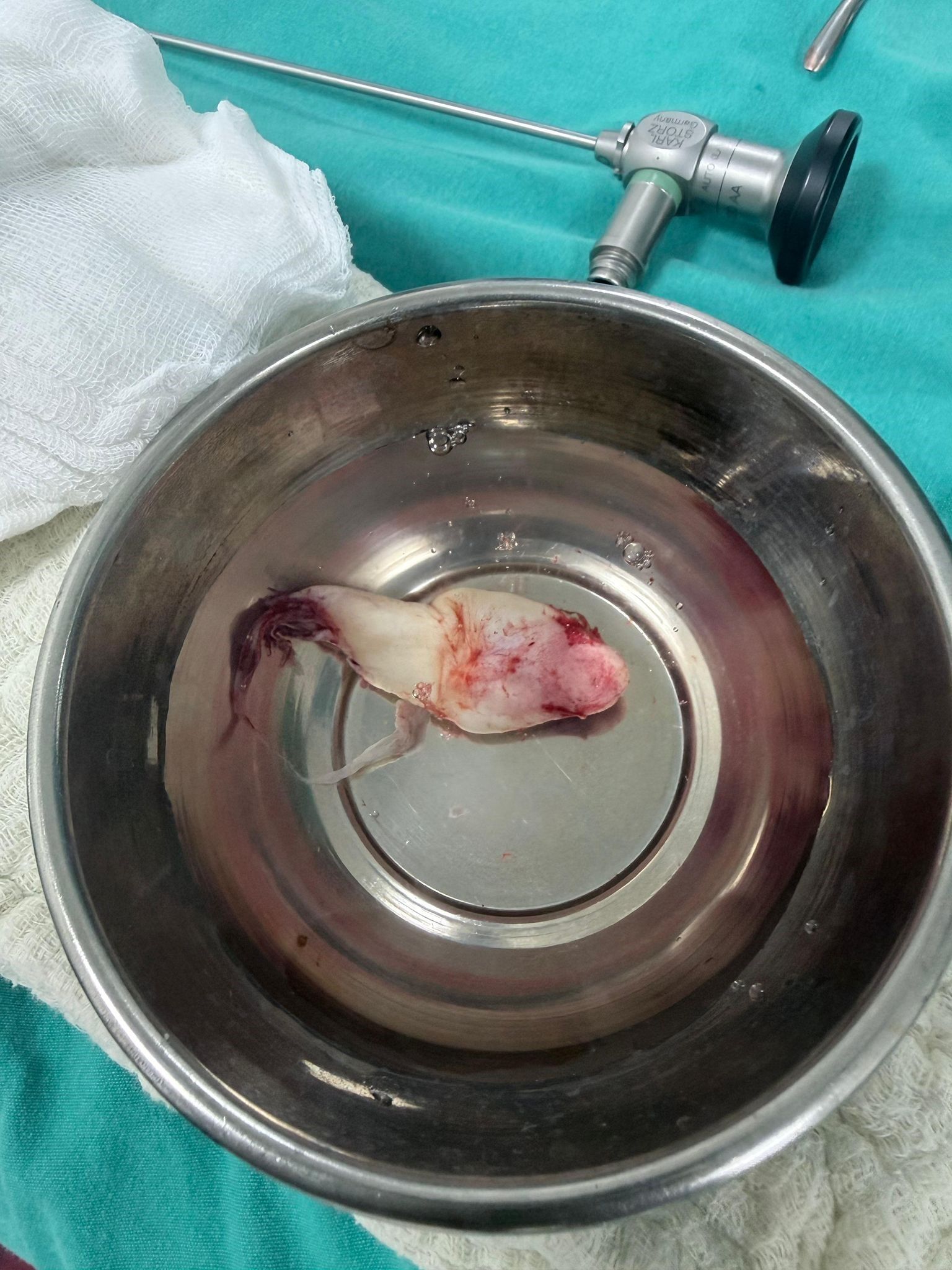 Burun Tıkanıklığı Şikayetiyle Gitti, Genizden Dev Polip Çıktı (1)