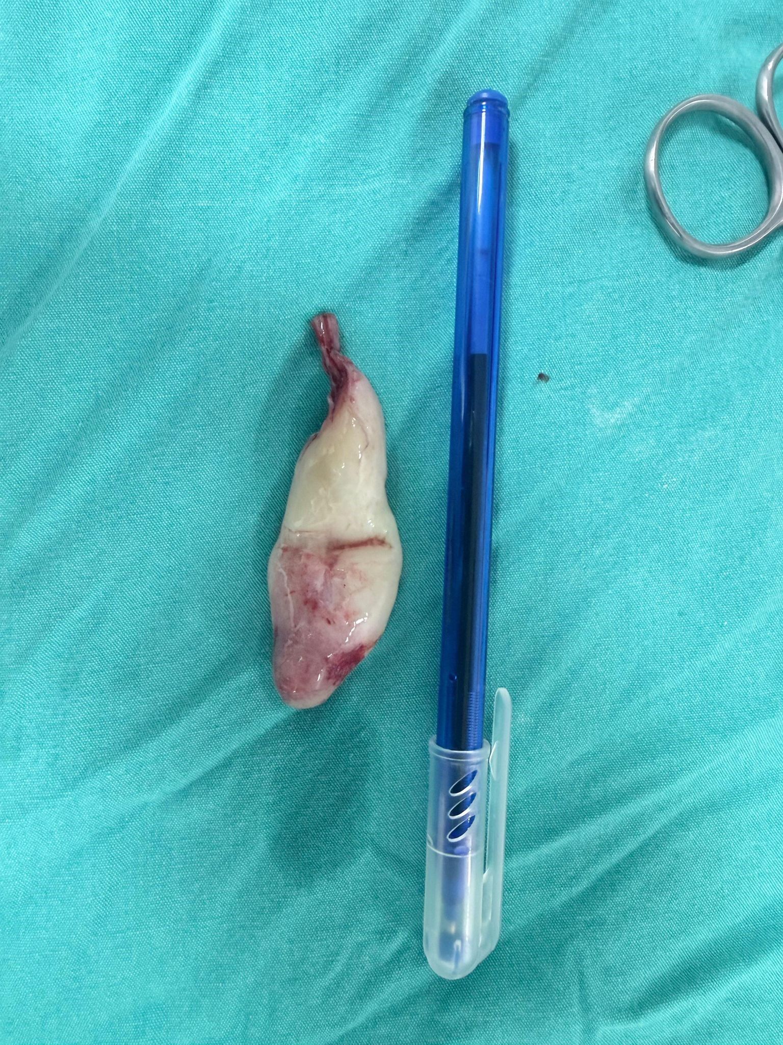 Burun Tıkanıklığı Şikayetiyle Gitti, Genizden Dev Polip Çıktı (7)